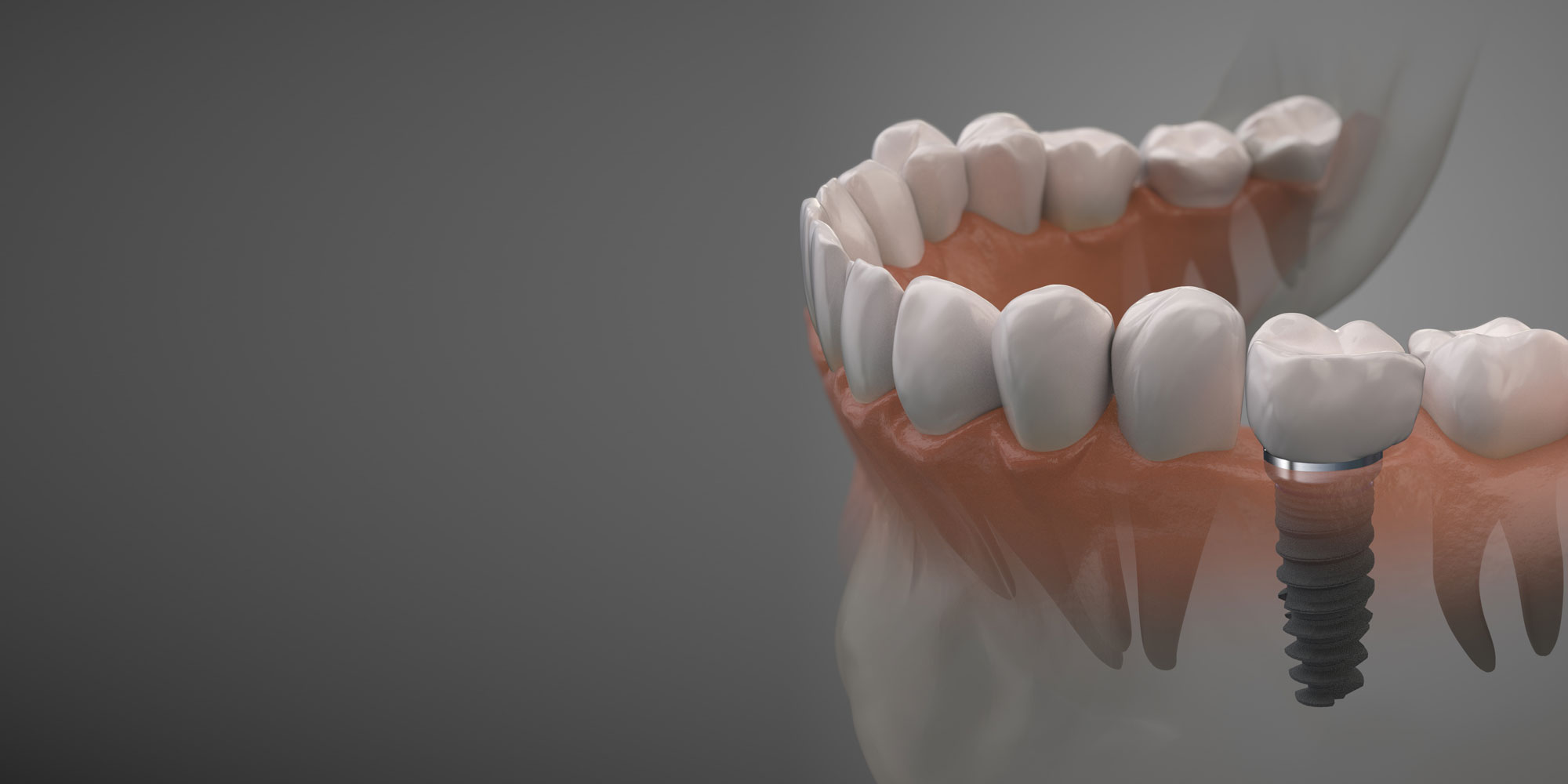 Can dental implants be done in one day?